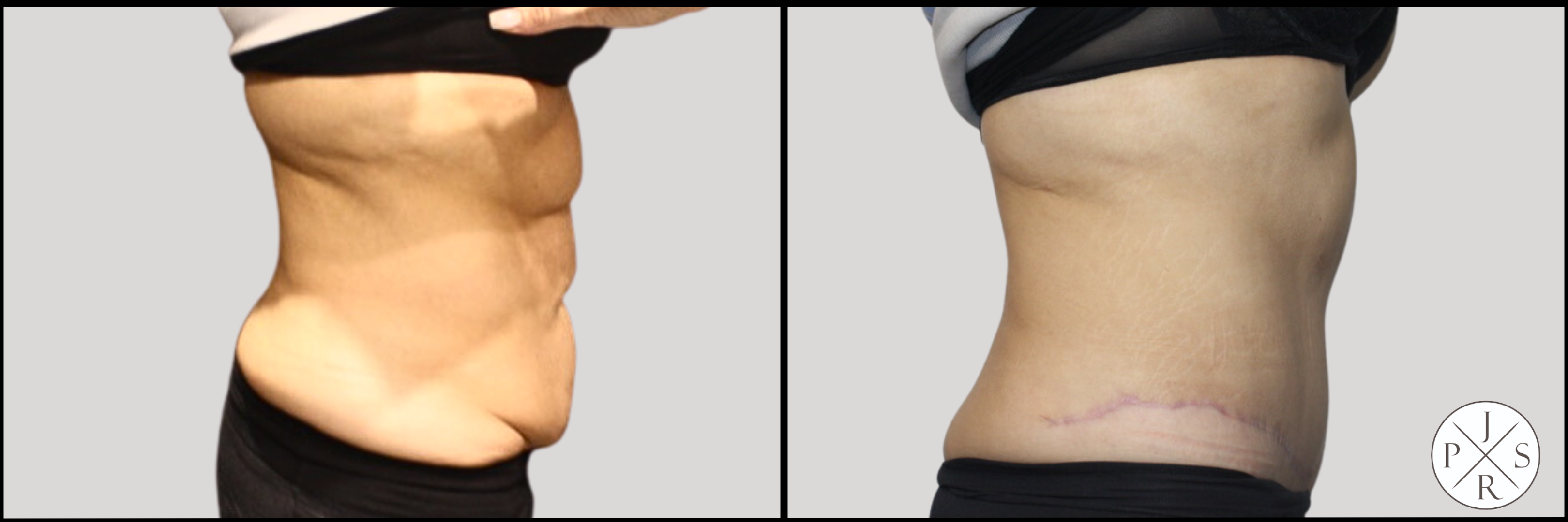 Abdominoplasty Before & After Image